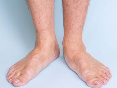 Übermäßige Pronation des Sprunggelenks – Was kann man tun?