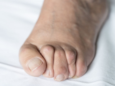 Hammerzehen - was Sie über diese Fußdeformität wissen müssen