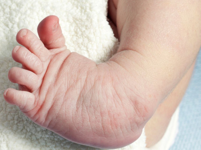 Klumpfuß: Ein umfassender Leitfaden zu Ursachen, Symptomen und Behandlung