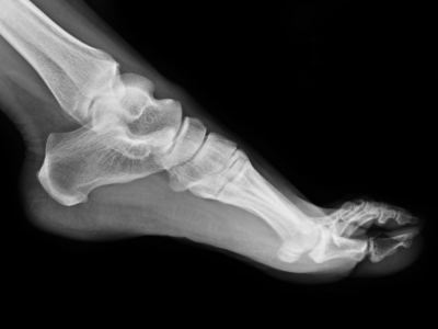 Dämpfungsmechanismen des Fußes – was gewinnen wir, wenn wir Barfußschuhe tragen?